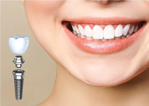 Dental implants