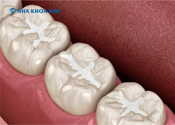 Dental fillings