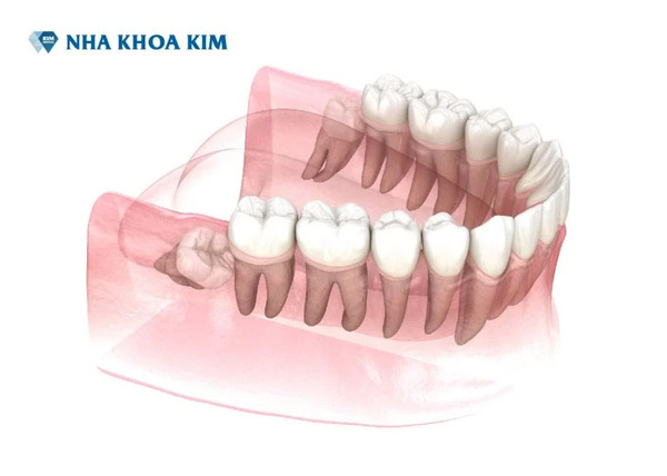 Wisdom tooth extraction