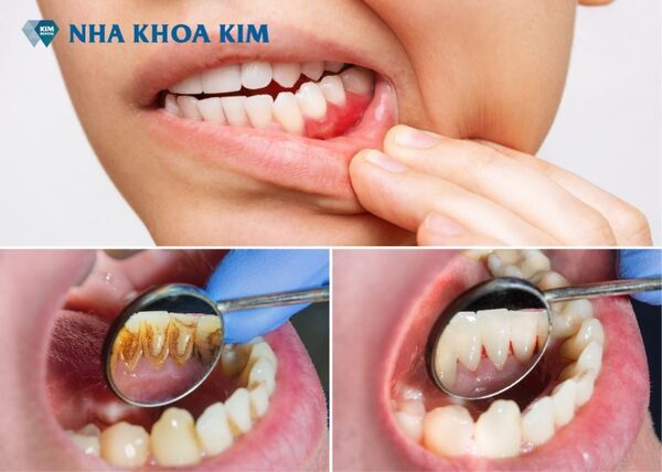 Periodontal treatment