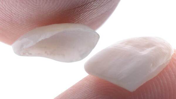 Porcelain veneers