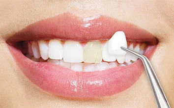 Porcelain veneers