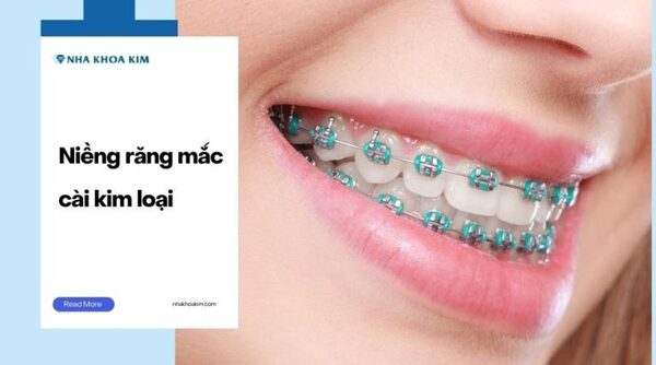 Traditional metal braces