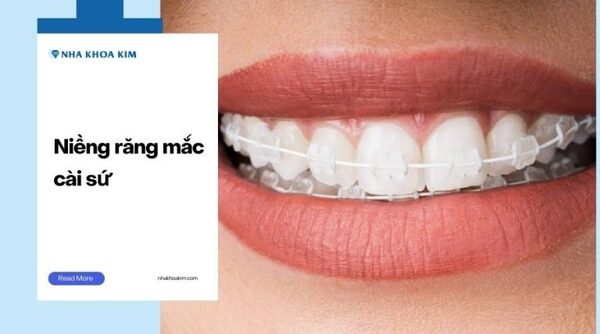 Ceramic braces