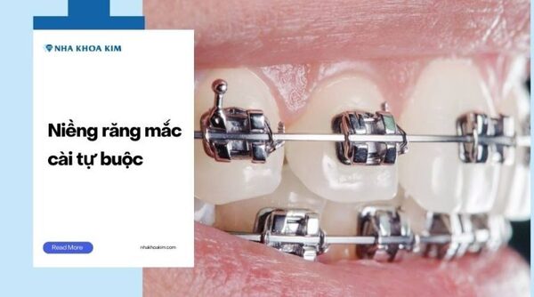 Self-ligating braces