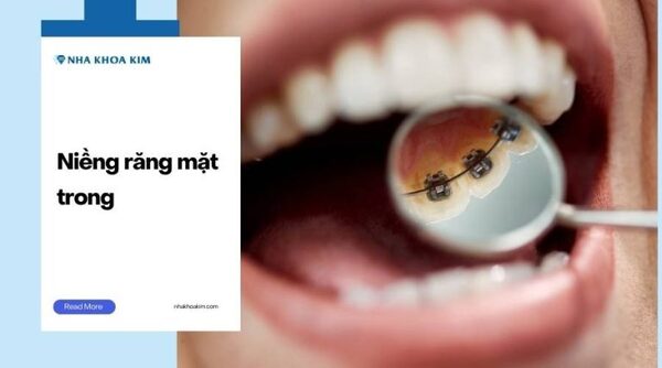 Lingual braces
